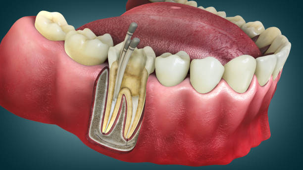 Re-Root Canal