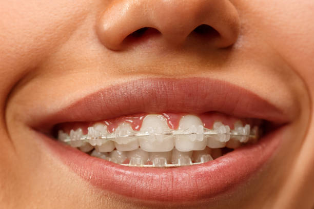 Ceramic Braces (Self Legating)