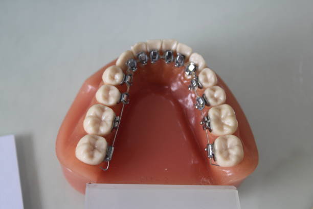 Lingual Braces