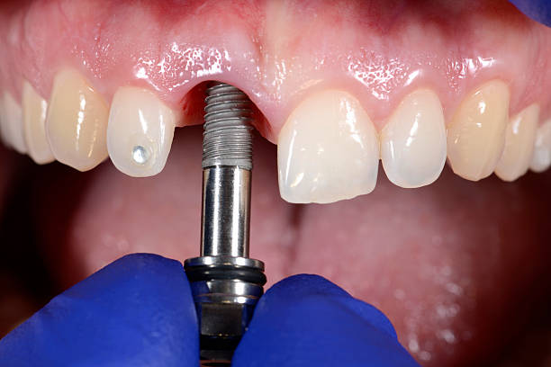 Basal Implant (Without Crown)
