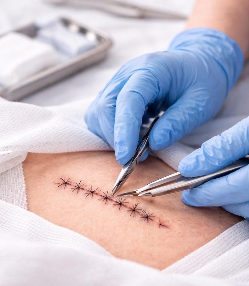 Suture /Stapler Removal (+/-)Dressing